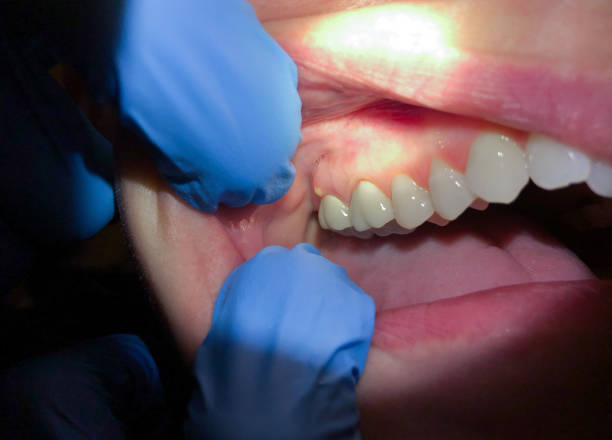 Best Broken or Chipped Tooth Repair in Cleveland, AL